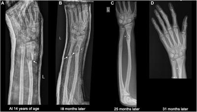 Case Report: Non-ossifying fibromas with pathologic fractures in a patient with NONO-associated X-linked syndromic intellectual developmental disorder